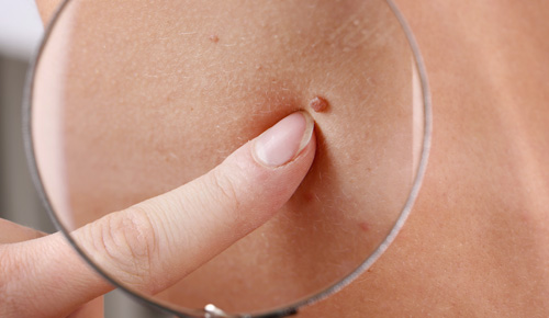 Doctor using magnifying glass to look at mole